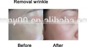 Ultra Pulse Co2 Laser for Skin Resurfacing, Smooth Scars thumbnail-3