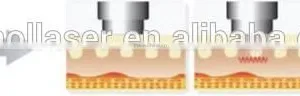 Beauty ROYAL- FR116 Equipment Microneedle Fractional RF Machine thumbnail-6