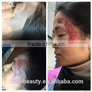q Switch nd Yag Laser Tattoo Removal Beauty Salon Equipment Supplier thumbnail-5