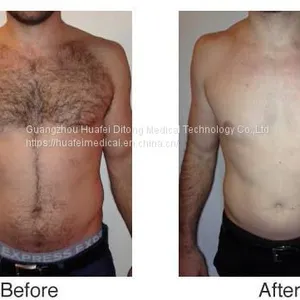 500W Best Diode Laser Hair Removal Beauty Machine thumbnail-5
