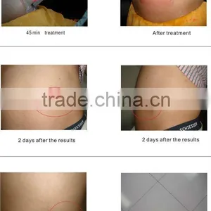 HOT SELLING !!Fat Frozen Equipment Cryolipolysis Slimming Equipment thumbnail-6