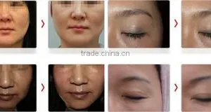 Hifu Face Lifting Wrinkle Removal Skin Tightening Device/face Lift Hifu Machine 7MHZ thumbnail-6
