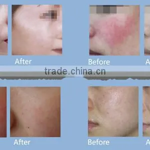 Portable 980nm Diode Laser Vascular&red Vein Removal Beauty Equipment thumbnail-6