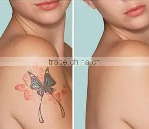 1064nm 532 nm Wavelength Tattoo Removal / Pigmentation Removal nd Yag Laser Machine for Sale thumbnail-6