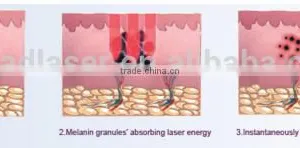 2016 Best Laser Skin Spot Remover Machine thumbnail-5