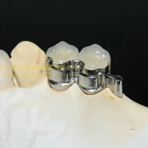 Dental Precision Attachment, Dental Attachment, Dental Denture, Laboratoire Dentaire, Dentallabor, Laboratorio Dental, Dental Laboratory, Shenzhen LJ Dental Lab China thumbnail-2