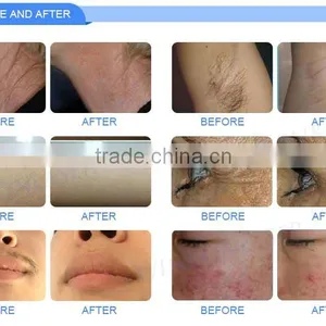 Fast Effect Shr Laser Skin Tightening Opt Hair Removal Machine for Whitening thumbnail-6