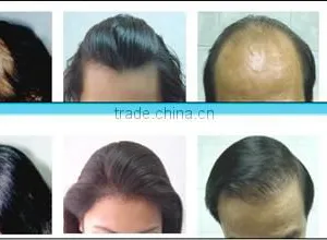 ce Approval Diode Laser Hair Regrowth Machine/laser Cap for Hair Regrowth thumbnail-5