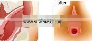 New Arrival Private Rejuvenation Vaginal Tightening Hifu System With 2 Transducer thumbnail-6