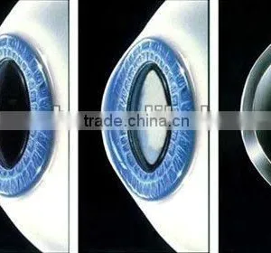 The High-end MCT Technology for Control and Treatment of Pathologic Myopia thumbnail-1