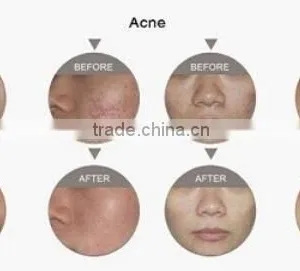 Eliminate Body Odor YUWEI Fractional Co2 Laser Vaginal Tightening & Acne Scar Removal Co2 Laser Machine Vagina Cleaning thumbnail-6
