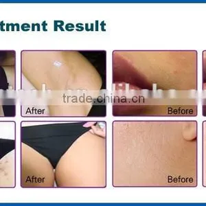 2016 Distributors Wanted Perfect Diode Laser 808nm Hair Removal Device With CE,ROHS thumbnail-4