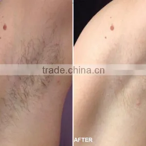 Ipl Rosacea Treatment thumbnail-6