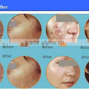 Fractional Co2 Laser Scar and Pigment Removal Device/co2 Laser for Skin Rejuvenation thumbnail-6