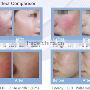 China Top Ten Selling Products Vascular Vein Removal / Varicose Veins Laser Treatment Machine thumbnail-3