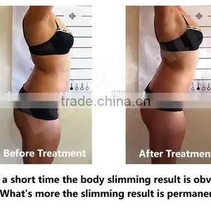Liposuction Machine Plastic Surgery Equipment Vacuum Suction Devices Type Liposuction thumbnail-2