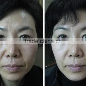 High Frequency Operation System and Anti-Puffiness/Skin Tightening/Wrinkle Remover Feature HIFU Face Lift thumbnail-4