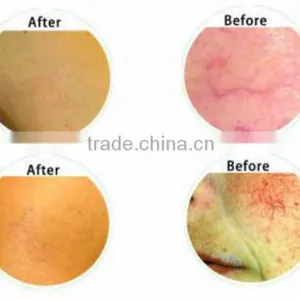 Best Selling Products! Laser Vein Removal Machine for Sale 980nm Diode Laser Vascular Removal Thread Vein Removal thumbnail-6