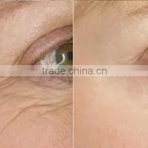2017 Most Effective Microneedle Skin Tightenting Fractional rf Machine Wrinkle Removel With High Quality thumbnail-6
