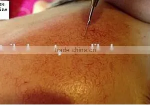 Effective Manufactory Price !!! Only One Treatment! Removing Vascular Vein/blood Vessels/spider Vein Machine thumbnail-6