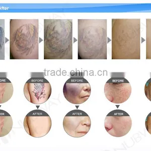New Products 2016 Innovative Product Q Switch ND YAG Laser Tattoo Removal Machine thumbnail-4