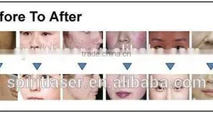 Express Acne Light, Elight Ipl Rf Nd Yag Laser, Light Ipl thumbnail-3