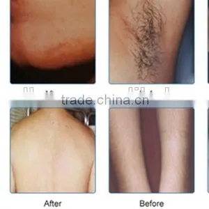 Remove Tiny Wrinkle Shr Ipl Rf Elight Yag Wrinkle Removal Beauty Device IPL Laser Shr Vascular Treatment thumbnail-5