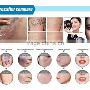 Hot Selling Import Laser Bar Portable Q-switched Nd:yag Laser Tattoo Removal Device thumbnail-6