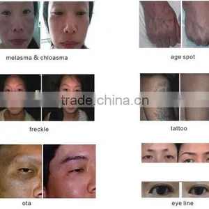 New Laser Handle Best Design nd Yag Laser Price thumbnail-6