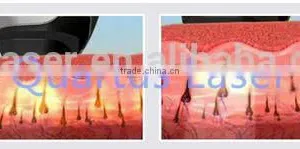 755nm Device / Beauty Machine/ Beauty Equipment Laser Alexandrite to Remove Armpit Hair thumbnail-4