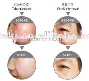 Face Lifting  New Design Multi-functions IPL Equipment For Beauty Salon Whitening Skin thumbnail-5