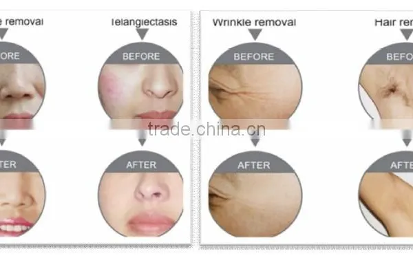 SUSLASER Elight Laser Hair Removal Machine photo-5