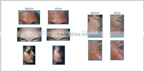 Hot Selling YUWEI Facial Skin Care Lifting Eye Wrinkle Removal Eye Care Massage photo-6