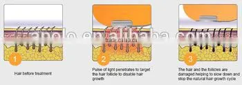 Hot Sale Apolomed HS-310C Multifunction Ipl photo-4