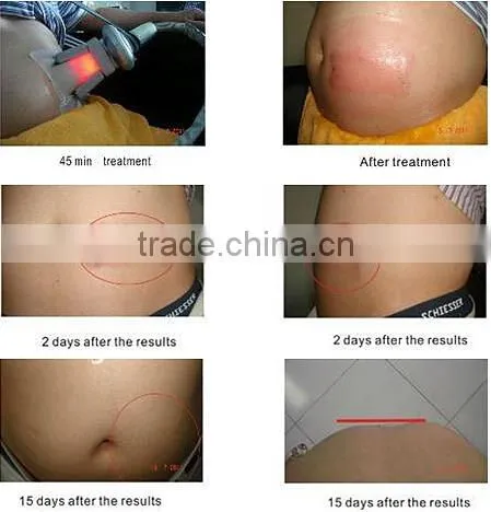 Fat Reduce Cooling Slimming Weight Loss Zeltiq Machine Cryolipolysis Fat Reducing photo-6