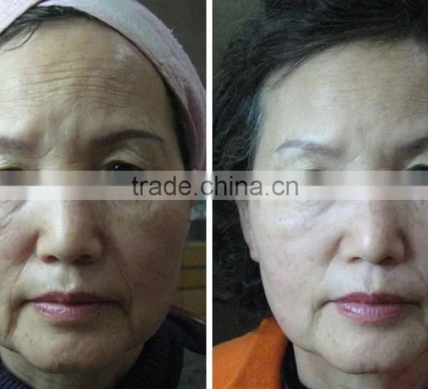 High Frequency Operation System and Anti-Puffiness/Skin Tightening/Wrinkle Remover Feature HIFU Face Lift photo-3