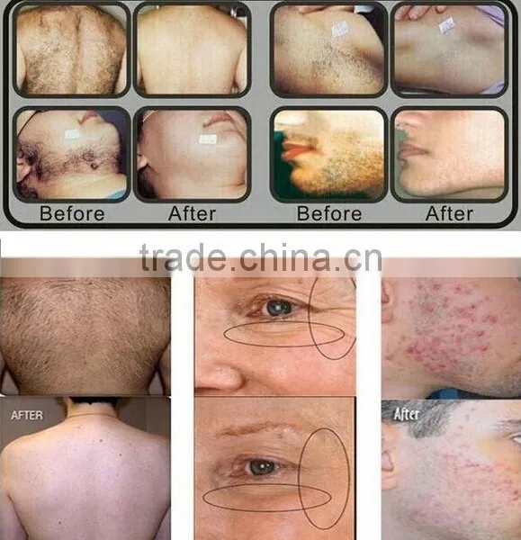Alexandrite Laser no Pain Strong Power Hair Removal Machine 808 Diode Face Body Hair Rmeoval photo-6