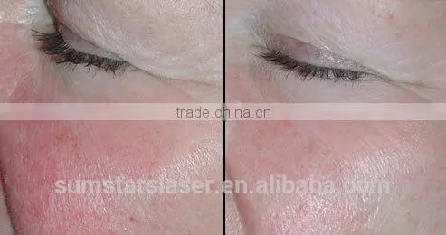 8.4 Inch Touch Screen Vascular Removal /High Frequency Vascular Removal photo-3