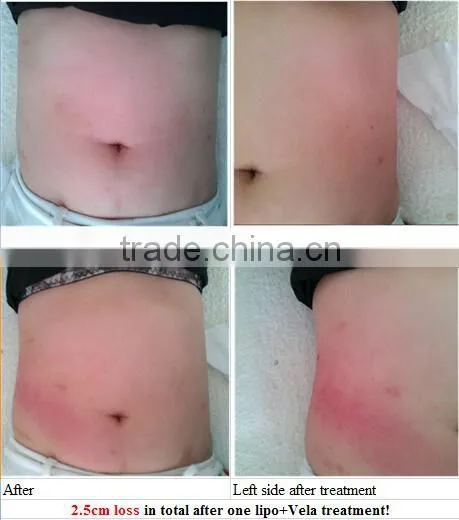 SUS 650nm Lipo Laser Fat Removal Machine/ Laser Slimming Machine photo-5