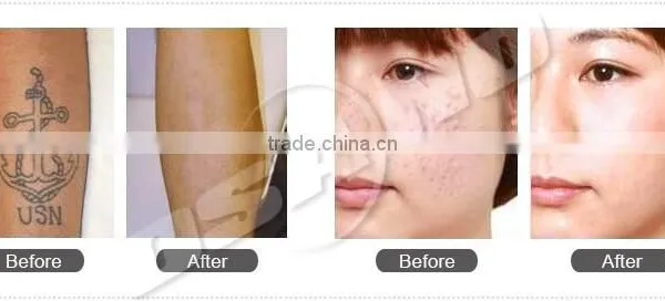 1 HZ 2015 Laser Tattoo Laser Removal Tattoo Machine Removal Machine Price Vascular Tumours Treatment photo-6