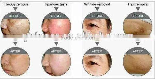 755+1064 Alexandrite Laser Permanent Hair Removal Machine Pigmentation Correctors photo-3