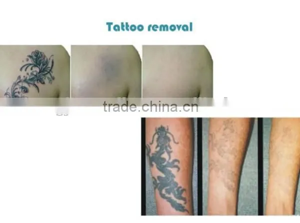 Portable Beauty Products Long Pulse Nd 1064nm Yag Laser /Easy Work Professional Laser Permanent Tattoo Removal photo-4