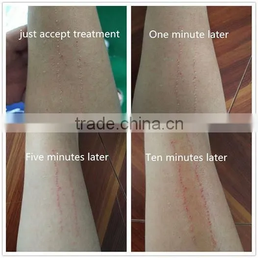Professional Medical nd Yag Laser/q Switch nd Yag Laser Tattoo Removal Machine/ 532nm 1064nm Laser Pigmentation Removal Machine photo-3