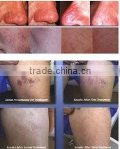 High Frequency Vascular Remvoal Machine/Beauty Salon Used Vascular Remvoal Device for Sale photo-6