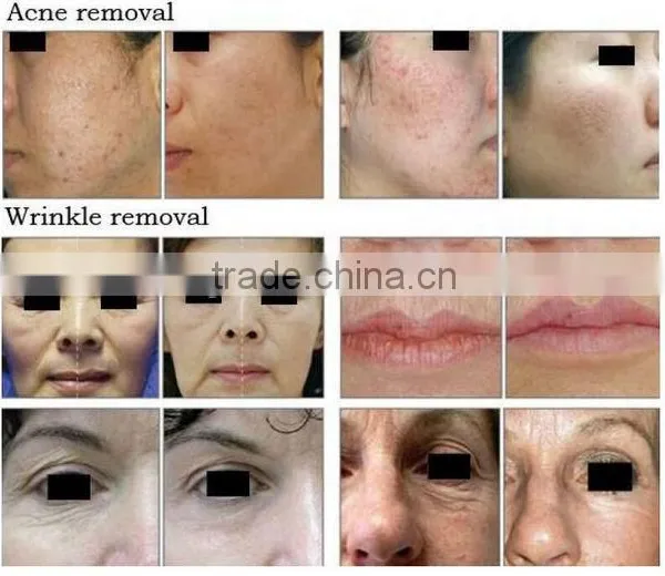 Sun Damage Recovery RF Co2 Laser /RF Metal Tube Fractional Co2 8.0 Remove Neoplasms Inch Laser Machine With Vaginal Tightening / Rf Tube CO2 photo-2