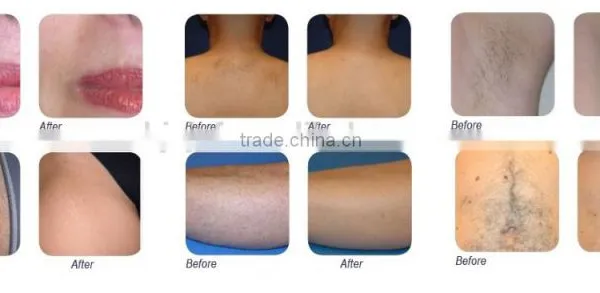 Diode Laser Generator 600w, Perfect Hair Removal Effect photo-6