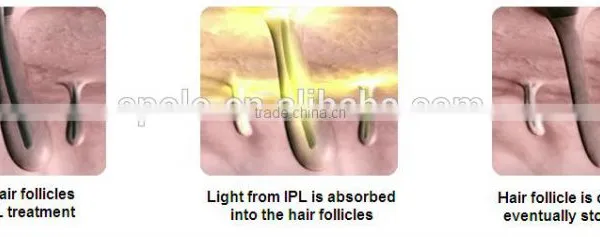 New Technolgoy Apolomed HS-350E Spa Shr Ipl Hair Removal photo-6