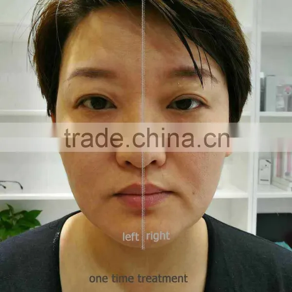 YUWEI New Technology 2D Dimision Hifu/ Portable Face Lifting 2D Hifu Machine For Face And Body 0.1-2J photo-6