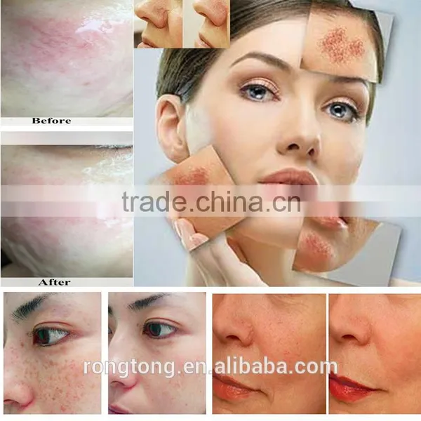 Cheap Price Permanent Hair Removal Machine Ipl Hair Removal Skin Rejuvenation e Light Ipl rf Skin Lifting Hair Removal photo-6
