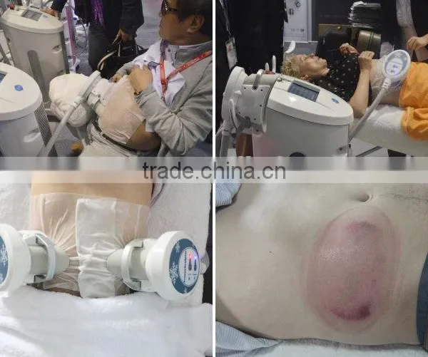 Body Shaping Machine/ Cool Slimming Machine/ Cool Tech Fat Freezing Machine photo-6